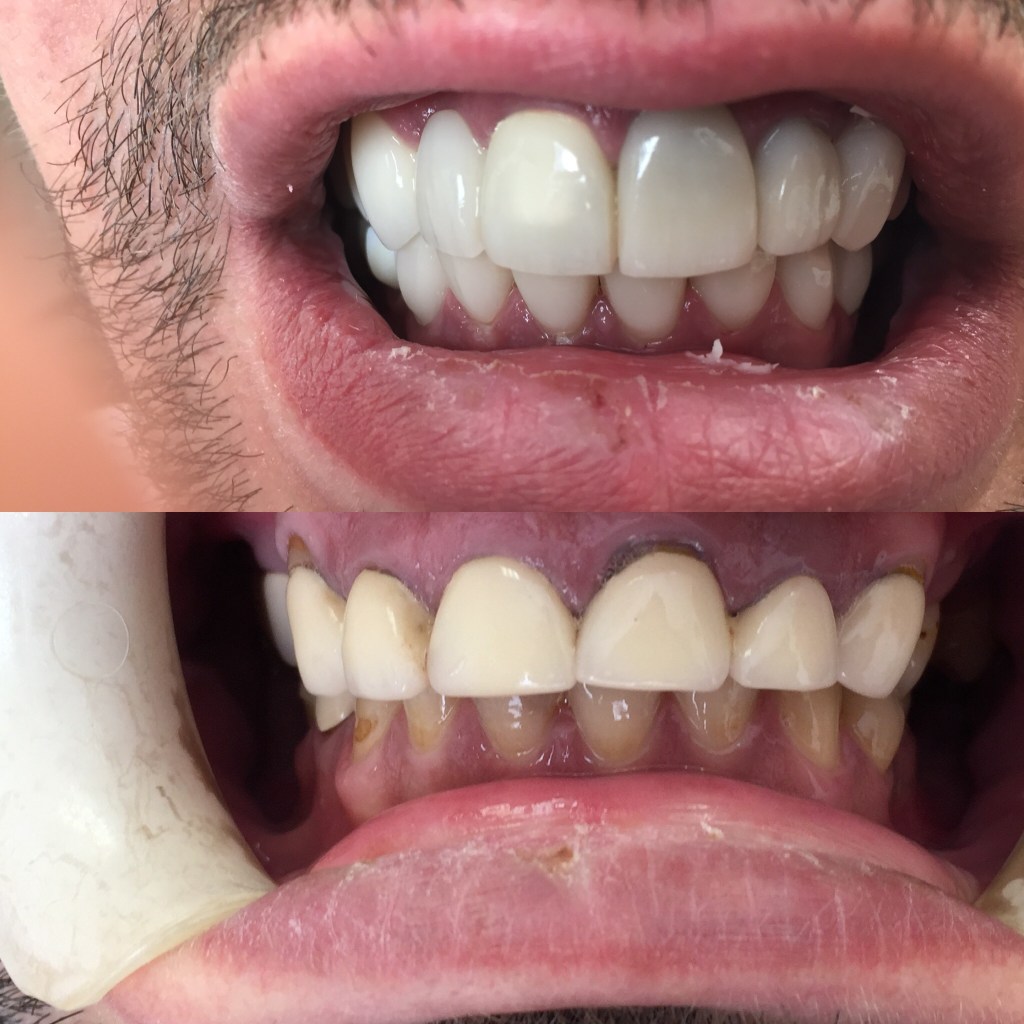 Cosmetic Tooth Bonding Plano TX